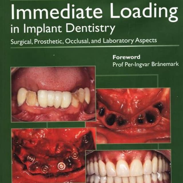Immediate Loading in Implant Dentistry: Surgical, Prosthetic, Occlusal, And Laboratory Aspects